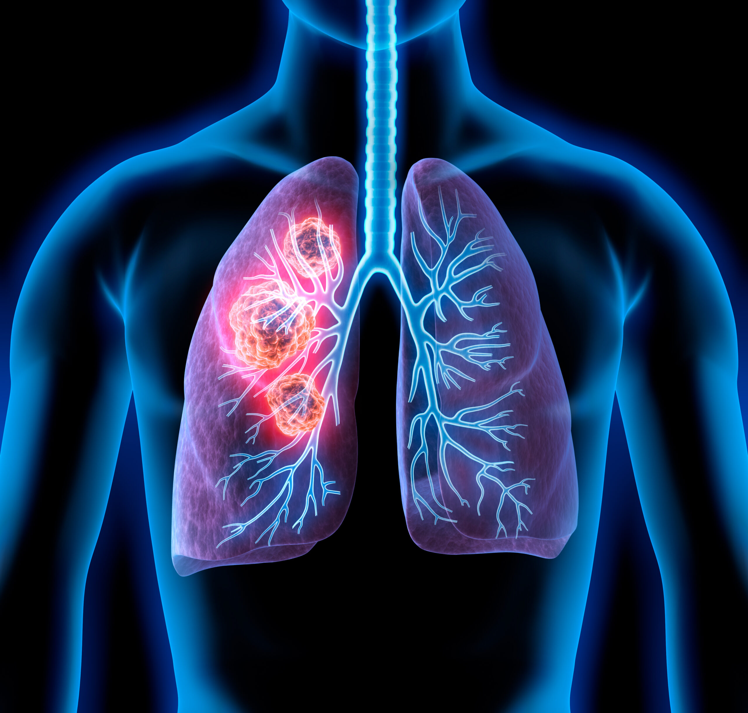 AI Shines in Predicting Lung Cancer Survival